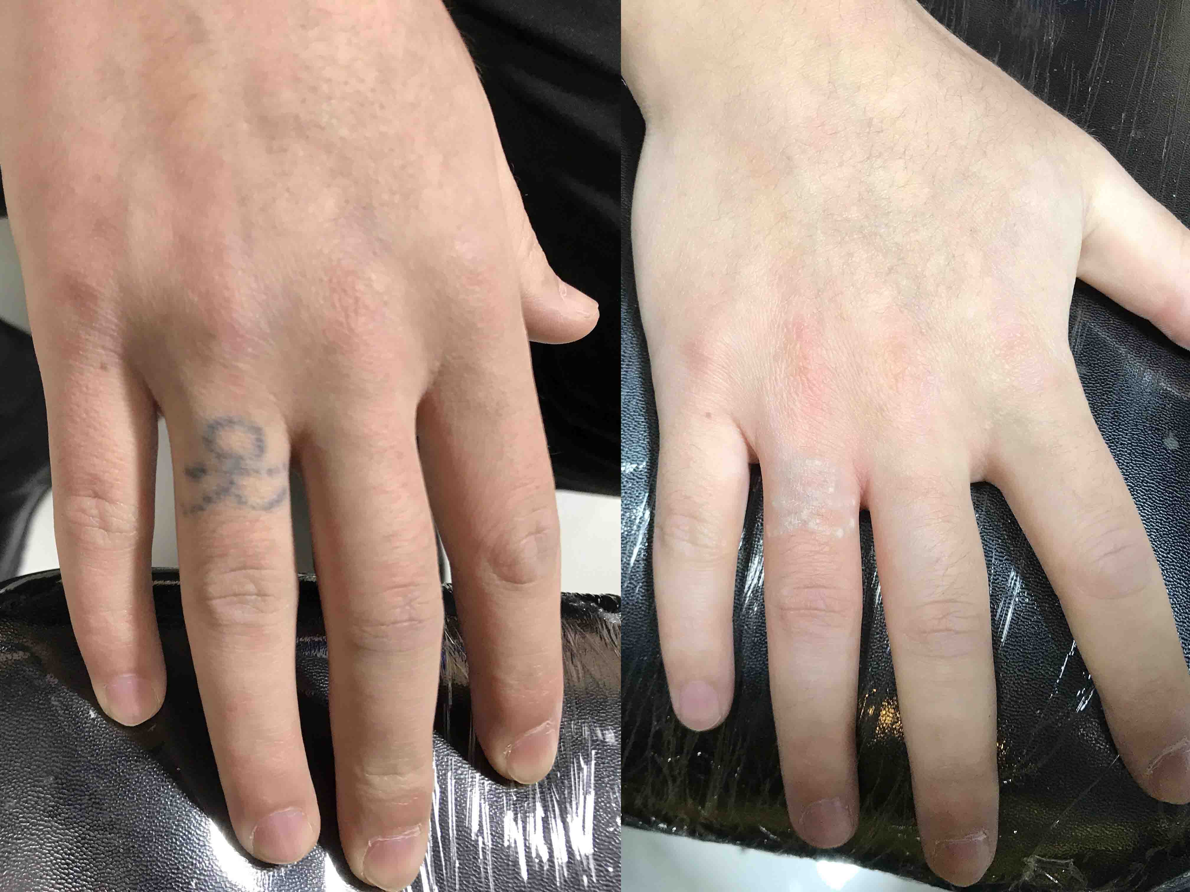 乌鲁木齐洗纹身.jpg5564.jpg3435.jpg 乌鲁木齐洗纹身.jpg5564.jpg3435.jpg